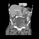 Carcinoma of urinary bladder, invasion into prostate: CT - Computed tomography